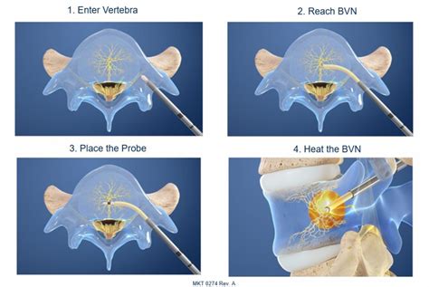 Intracept Procedure - Restore Medical Partners | Venice, FL