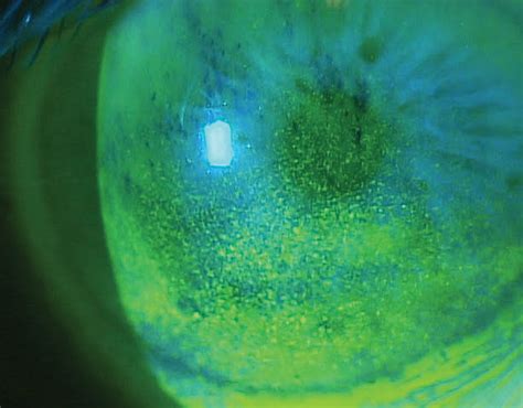 Punctate Epithelial Keratitis