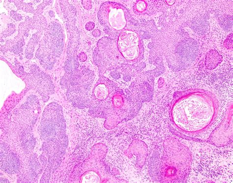 Pathology Outlines - Trichoepithelioma / trichoblastoma