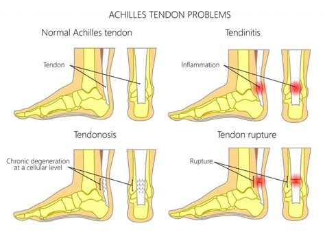 Mid-Portion Achilles Tendinopathy: Learn how to treat it