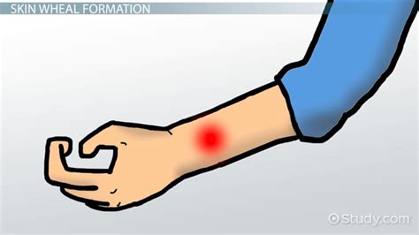 Wheal Skin Lesion | Definition, Formation & Treatment - Lesson | Study.com