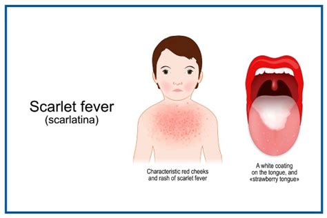 Scarlet Fever: Symptoms, Causes, Risk Factors, & Treatment