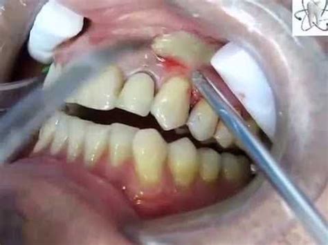 Abscess tooth removal | Tooth Abscess Extraction - YouTube