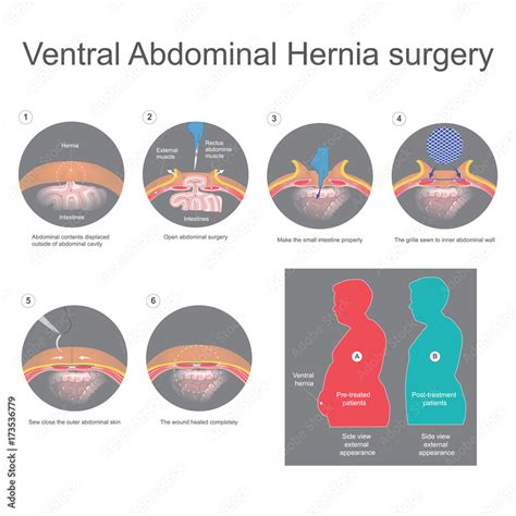 Ventral hernia is a bulge of tissues through an opening of weakness within your abdominal wall ...