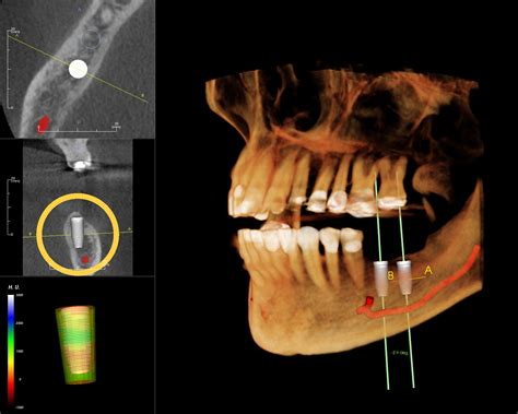 Dental Implant and CT Scan | A Dental Blog by Alex H. Nguyen, DDS