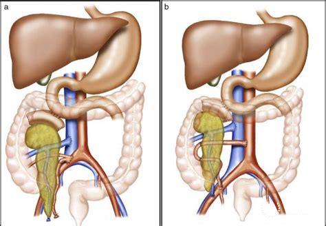 Pancreas transplantation