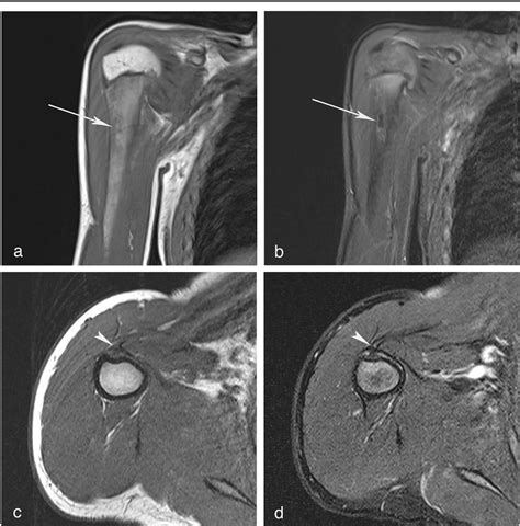 Irresti: Cortical Desmoid Mri