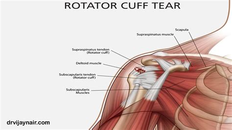 Rotator Cuff Injury: Causes, Diagnosis and Treatment, Bangalore