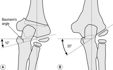 Orthopaedics and trauma: upper limb | Clinical Gate