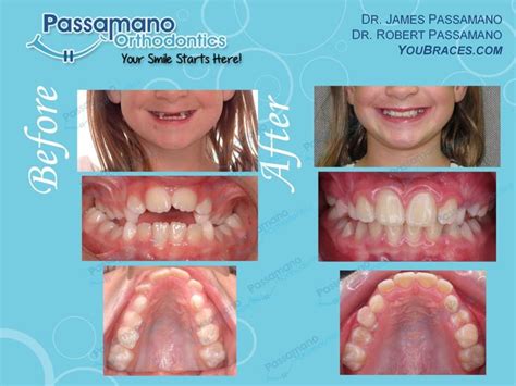 Orthodontics for Young Children - Irvine Orthodontists | Orthodontics, Orthodontist, Invisalign