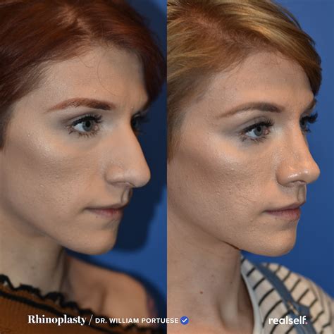 Rhinoplasty: The Ultimate Guide to a Nose Job - RealSelf | Rhinoplasty ...