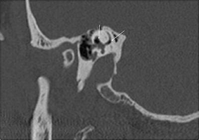 Frontiers | Perilymphatic Fistula: A Review of Classification, Etiology, Diagnosis, and Treatment