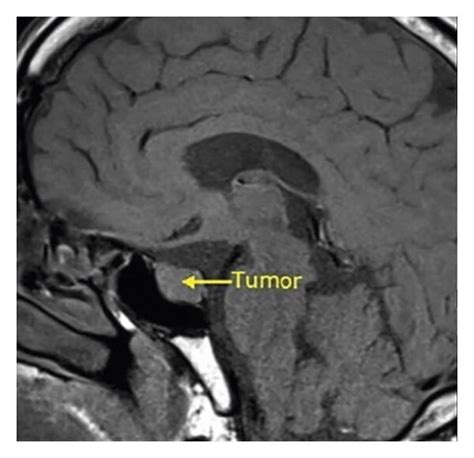 (a) MRI of the sella turcica region showing tumor lesions. The yellow... | Download Scientific ...