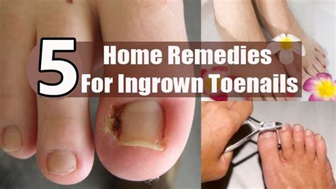 5 Home Remedies for Infected Ingrown Toenails | By Top 5. - YouTube