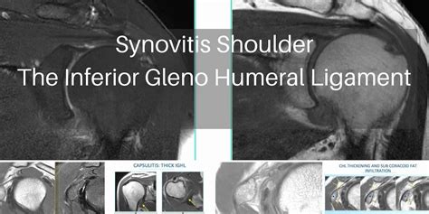 MRI SYNOVITIS SPECIFIC SITES IN THE SHOULDER: THE INFERIOR GLENOHUMERAL ...