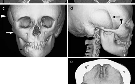 Lion’s face – symptoms, differentiation, treatment. What is Cranio-Molar Dysplasia? – Healthy ...