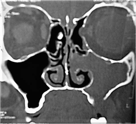 Left maxillary sinusitis (total opacification) with blockage of the ...