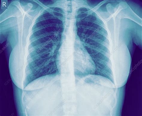 Normal healthy Chest x-ray - Stock Image - C019/7307 - Science Photo ...