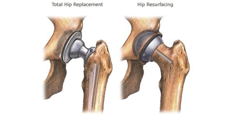 Hip Resurfacing vs Total Arthroplasty: New Data | Orthopedics This Week