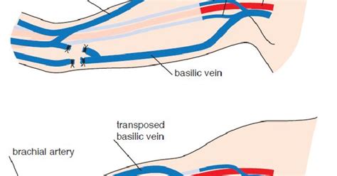 Picc Line Brachial Vein