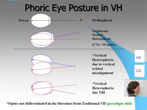 Identification Of Binocular Vision Dysfunction (Vertical, 44% OFF