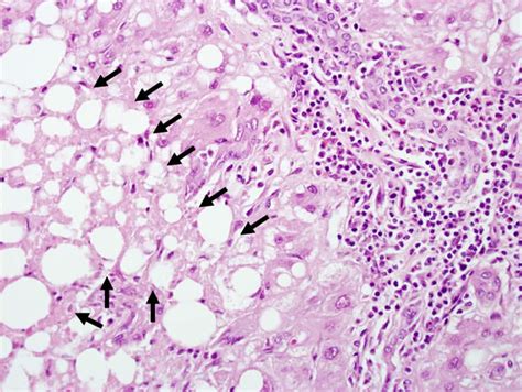 Acute Hepatic Necrosis - LiverTox - NCBI Bookshelf