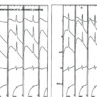 (a) Early Wenckebach phenomenon appearance during atrial pacing (cycle ...