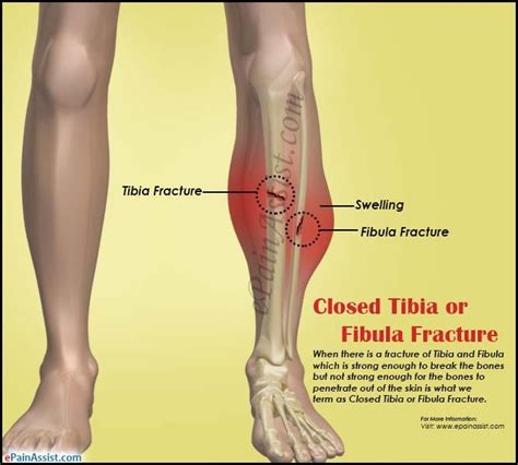 Closed Tibia or Fibula Fracture | Treatment recovery, Treatment, Fractures