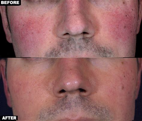 Laser Surgery: Laser Surgery Rosacea Nose Redness Treatment