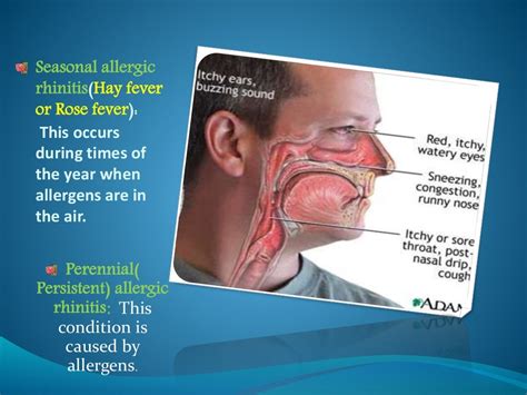 Allergic rhinitis