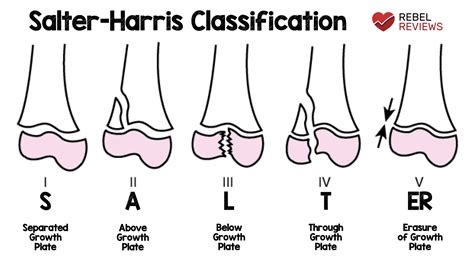 Salter Harris Fracture Classifications Drawings Show The Normal Physis | My XXX Hot Girl