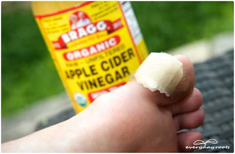 10 Common Remedies to Get Rid of Warts | Everyday Roots