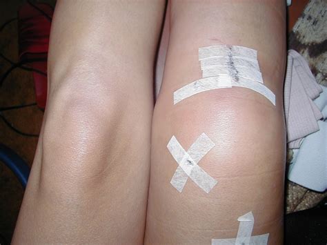 Knee Surgery to Repair the Meniscus Show High Failure Rate