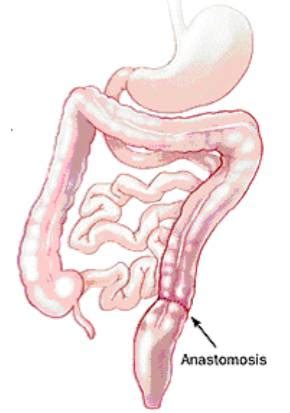 Reversal of Hartmann’s Procedure - Milton Keynes University Hospital