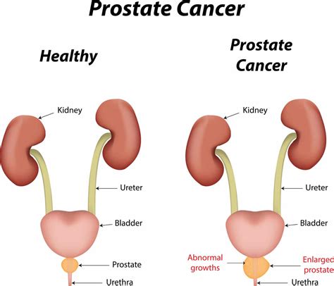 Multivitamin use may reduce prostate Ca recurrence - Urology of Virginia