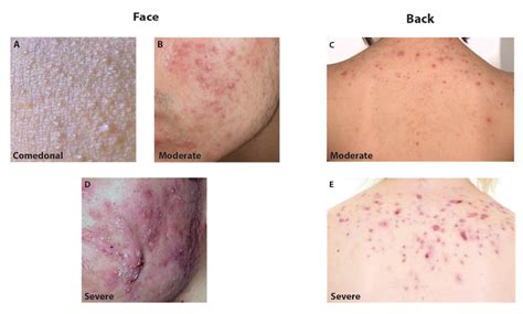 The New Canadian Guideline for Acne Treatment