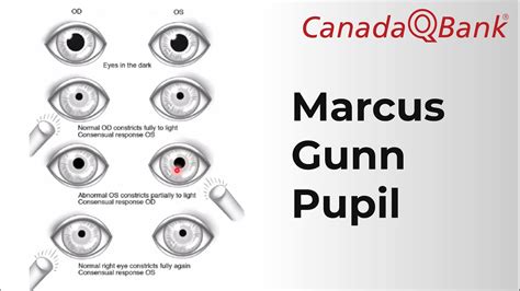 Marcus Gunn Pupil - YouTube