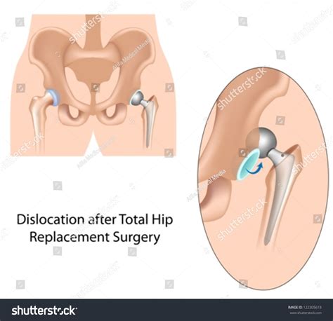 Dislocation After Hip Replacement Surgery Stock Vector (Royalty Free ...