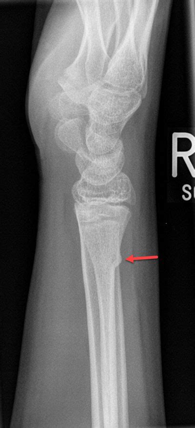 Torus (Buckle) Fracture - Radiology For Beginners by Dr. Samuel Kobba