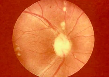 Retinal Vasculitis Overview Flashcards | Quizlet