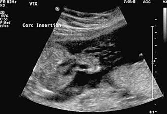 Trisomy 13 | Radiology Key