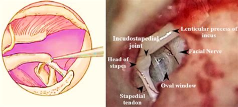 ear - OTOSCLEROSIS - Dr. Meenesh Juvekar - ENT Specialist