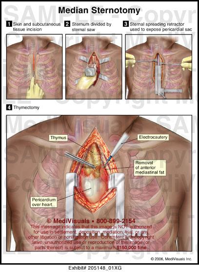 Median Sternotomy Medical Illustration