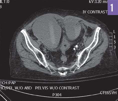 Rectus Sheath Hematoma | Consultant360