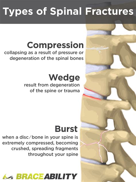 L1 Compression Fracture - Figgymcfatty