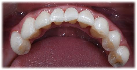 The aesthetic anterior veneers restorations with digital technology