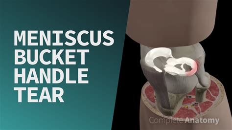 Meniscus Bucket Handle Tear - YouTube