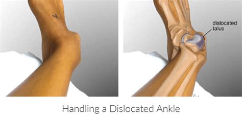 Handling a Dislocated Ankle