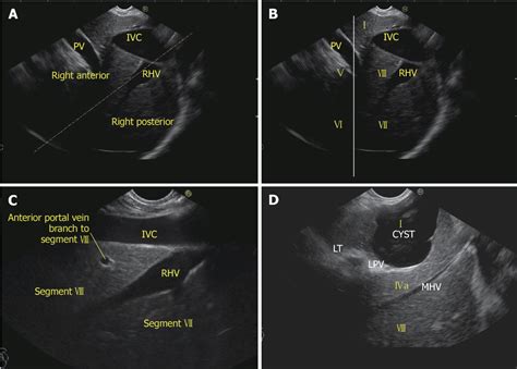 Liver Ultrasound Anatomy