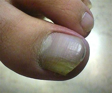 NAIL DISEASES - Onychomycosis due to Tr. rubrum infection picture ...